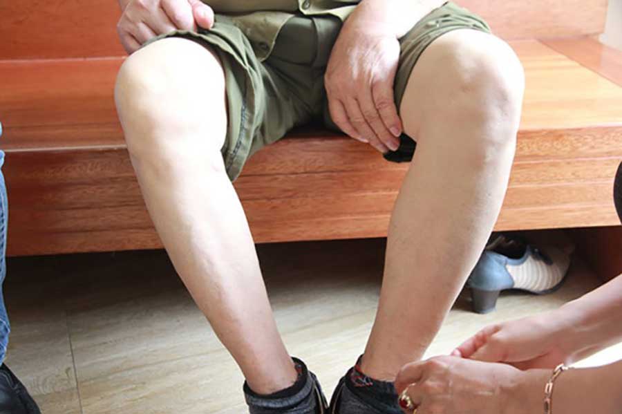 Đôi chân suýt bị cắt vì tắc mạch của ông Nguyễn Văn Nhuận, giờ đã bình thường.